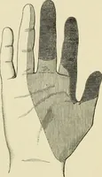 An illustration from Practical diagnosis: the use of symptoms in the diagnosis of disease / By Hobart Amory Hare ... Illustrated with 191 engravings and 13 colored plates. (1896)