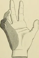An illustration from Practical diagnosis: the use of symptoms in the diagnosis of disease / By Hobart Amory Hare ... Illustrated with 191 engravings and 13 colored plates. (1896)