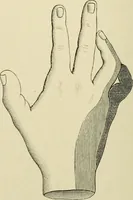 An illustration from Practical diagnosis: the use of symptoms in the diagnosis of disease / By Hobart Amory Hare ... Illustrated with 191 engravings and 13 colored plates. (1896)