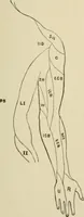 An illustration from Practical diagnosis: the use of symptoms in the diagnosis of disease / By Hobart Amory Hare ... Illustrated with 191 engravings and 13 colored plates. (1896)