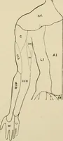 An illustration from Practical diagnosis: the use of symptoms in the diagnosis of disease / By Hobart Amory Hare ... Illustrated with 191 engravings and 13 colored plates. (1896)