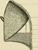 An illustration from Practical diagnosis: the use of symptoms in the diagnosis of disease / By Hobart Amory Hare ... Illustrated with 191 engravings and 13 colored plates. (1896)