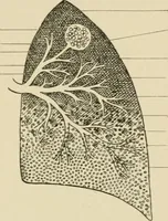 An illustration from Practical diagnosis: the use of symptoms in the diagnosis of disease / By Hobart Amory Hare ... Illustrated with 191 engravings and 13 colored plates. (1896)