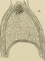 An illustration from Practical diagnosis: the use of symptoms in the diagnosis of disease / By Hobart Amory Hare ... Illustrated with 191 engravings and 13 colored plates. (1896)