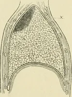 An illustration from Practical diagnosis: the use of symptoms in the diagnosis of disease / By Hobart Amory Hare ... Illustrated with 191 engravings and 13 colored plates. (1896)