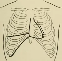An illustration from Practical diagnosis: the use of symptoms in the diagnosis of disease / By Hobart Amory Hare ... Illustrated with 191 engravings and 13 colored plates. (1896)