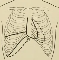 An illustration from Practical diagnosis: the use of symptoms in the diagnosis of disease / By Hobart Amory Hare ... Illustrated with 191 engravings and 13 colored plates. (1896)