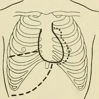 An illustration from Practical diagnosis: the use of symptoms in the diagnosis of disease / By Hobart Amory Hare ... Illustrated with 191 engravings and 13 colored plates. (1896)