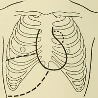 An illustration from Practical diagnosis: the use of symptoms in the diagnosis of disease / By Hobart Amory Hare ... Illustrated with 191 engravings and 13 colored plates. (1896)