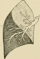 An illustration from Practical diagnosis: the use of symptoms in the diagnosis of disease / By Hobart Amory Hare ... Illustrated with 191 engravings and 13 colored plates. (1896)
