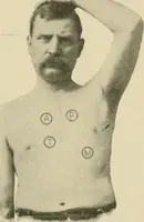 An illustration from Practical diagnosis: the use of symptoms in the diagnosis of disease / By Hobart Amory Hare ... Illustrated with 191 engravings and 13 colored plates. (1896)