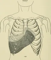 An illustration from Practical diagnosis: the use of symptoms in the diagnosis of disease / By Hobart Amory Hare ... Illustrated with 191 engravings and 13 colored plates. (1896)