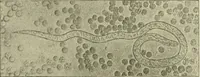 An illustration from Practical diagnosis: the use of symptoms in the diagnosis of disease / By Hobart Amory Hare ... Illustrated with 191 engravings and 13 colored plates. (1896)