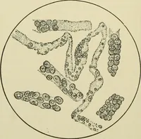 An illustration from Practical diagnosis: the use of symptoms in the diagnosis of disease / By Hobart Amory Hare ... Illustrated with 191 engravings and 13 colored plates. (1896)
