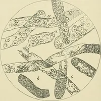 An illustration from Practical diagnosis: the use of symptoms in the diagnosis of disease / By Hobart Amory Hare ... Illustrated with 191 engravings and 13 colored plates. (1896)