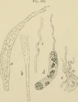 An illustration from Practical diagnosis: the use of symptoms in the diagnosis of disease / By Hobart Amory Hare ... Illustrated with 191 engravings and 13 colored plates. (1896)