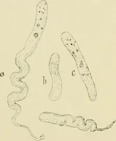An illustration from Practical diagnosis: the use of symptoms in the diagnosis of disease / By Hobart Amory Hare ... Illustrated with 191 engravings and 13 colored plates. (1896)
