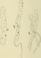 An illustration from Practical diagnosis: the use of symptoms in the diagnosis of disease / By Hobart Amory Hare ... Illustrated with 191 engravings and 13 colored plates. (1896)