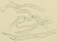 An illustration from Practical diagnosis: the use of symptoms in the diagnosis of disease / By Hobart Amory Hare ... Illustrated with 191 engravings and 13 colored plates. (1896)