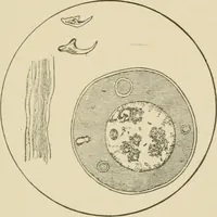 An illustration from Practical diagnosis: the use of symptoms in the diagnosis of disease / By Hobart Amory Hare ... Illustrated with 191 engravings and 13 colored plates. (1896)