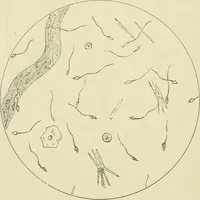 An illustration from Practical diagnosis: the use of symptoms in the diagnosis of disease / By Hobart Amory Hare ... Illustrated with 191 engravings and 13 colored plates. (1896)