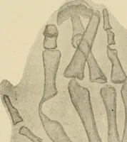 An illustration from Practical diagnosis: the use of symptoms in the diagnosis of disease / By Hobart Amory Hare ... Illustrated with 191 engravings and 13 colored plates. (1896)