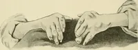 An illustration from Practical diagnosis: the use of symptoms in the diagnosis of disease / By Hobart Amory Hare ... Illustrated with 191 engravings and 13 colored plates. (1896)
