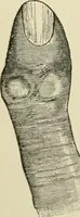 An illustration from Practical diagnosis: the use of symptoms in the diagnosis of disease / By Hobart Amory Hare ... Illustrated with 191 engravings and 13 colored plates. (1896)