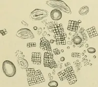 An illustration from Practical diagnosis: the use of symptoms in the diagnosis of disease / By Hobart Amory Hare ... Illustrated with 191 engravings and 13 colored plates. (1896)