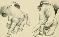 An illustration from Practical diagnosis: the use of symptoms in the diagnosis of disease / By Hobart Amory Hare ... Illustrated with 191 engravings and 13 colored plates. (1896)