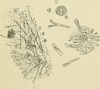 An illustration from Practical diagnosis: the use of symptoms in the diagnosis of disease / By Hobart Amory Hare ... Illustrated with 191 engravings and 13 colored plates. (1896)