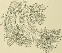 An illustration from Practical diagnosis: the use of symptoms in the diagnosis of disease / By Hobart Amory Hare ... Illustrated with 191 engravings and 13 colored plates. (1896)