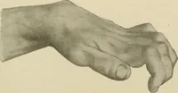 An illustration from Practical diagnosis: the use of symptoms in the diagnosis of disease / By Hobart Amory Hare ... Illustrated with 191 engravings and 13 colored plates. (1896)