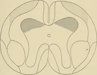 An illustration from Practical diagnosis: the use of symptoms in the diagnosis of disease / By Hobart Amory Hare ... Illustrated with 191 engravings and 13 colored plates. (1896)