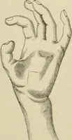 An illustration from Practical diagnosis: the use of symptoms in the diagnosis of disease / By Hobart Amory Hare ... Illustrated with 191 engravings and 13 colored plates. (1896)