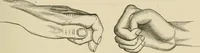 An illustration from Practical diagnosis: the use of symptoms in the diagnosis of disease / By Hobart Amory Hare ... Illustrated with 191 engravings and 13 colored plates. (1896)