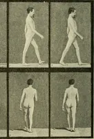 An illustration from Practical diagnosis: the use of symptoms in the diagnosis of disease / By Hobart Amory Hare ... Illustrated with 191 engravings and 13 colored plates. (1896)
