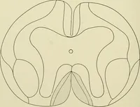 An illustration from Practical diagnosis: the use of symptoms in the diagnosis of disease / By Hobart Amory Hare ... Illustrated with 191 engravings and 13 colored plates. (1896)