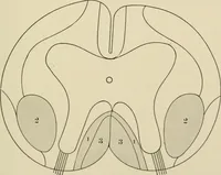 An illustration from Practical diagnosis: the use of symptoms in the diagnosis of disease / By Hobart Amory Hare ... Illustrated with 191 engravings and 13 colored plates. (1896)