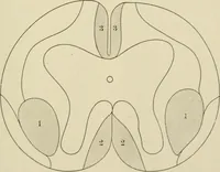An illustration from Practical diagnosis: the use of symptoms in the diagnosis of disease / By Hobart Amory Hare ... Illustrated with 191 engravings and 13 colored plates. (1896)