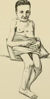 An illustration from Practical diagnosis: the use of symptoms in the diagnosis of disease / By Hobart Amory Hare ... Illustrated with 191 engravings and 13 colored plates. (1896)