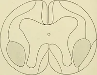 An illustration from Practical diagnosis: the use of symptoms in the diagnosis of disease / By Hobart Amory Hare ... Illustrated with 191 engravings and 13 colored plates. (1896)