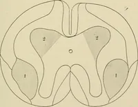 An illustration from Practical diagnosis: the use of symptoms in the diagnosis of disease / By Hobart Amory Hare ... Illustrated with 191 engravings and 13 colored plates. (1896)