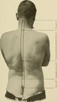 An illustration from Practical diagnosis: the use of symptoms in the diagnosis of disease / By Hobart Amory Hare ... Illustrated with 191 engravings and 13 colored plates. (1896)