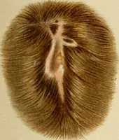 Picture 6 of 65 from Atlas and epitome of diseases caused by accidents / by Dr. Ed. Golebiewski ... authorized translation from the German, with editorial notes and additions by Pearce Bailey ... 40 colored plates, and 143 illustrations in black. (1900), leaf 105