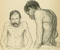 An illustration from Atlas and epitome of diseases caused by accidents / by Dr. Ed. Golebiewski ... authorized translation from the German, with editorial notes and additions by Pearce Bailey ... 40 colored plates, and 143 illustrations in black. (1900)