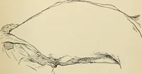 An illustration from Atlas and epitome of diseases caused by accidents / by Dr. Ed. Golebiewski ... authorized translation from the German, with editorial notes and additions by Pearce Bailey ... 40 colored plates, and 143 illustrations in black. (1900)