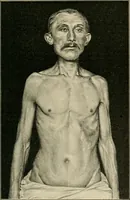 An illustration from Atlas and epitome of diseases caused by accidents / by Dr. Ed. Golebiewski ... authorized translation from the German, with editorial notes and additions by Pearce Bailey ... 40 colored plates, and 143 illustrations in black. (1900)