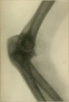 An illustration from Atlas and epitome of diseases caused by accidents / by Dr. Ed. Golebiewski ... authorized translation from the German, with editorial notes and additions by Pearce Bailey ... 40 colored plates, and 143 illustrations in black. (1900)