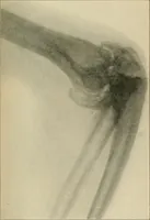 An illustration from Atlas and epitome of diseases caused by accidents / by Dr. Ed. Golebiewski ... authorized translation from the German, with editorial notes and additions by Pearce Bailey ... 40 colored plates, and 143 illustrations in black. (1900)